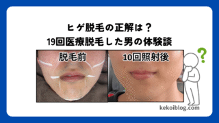 ヒゲ脱毛の正解は?3つのクリニックで19回医療脱毛した体験談