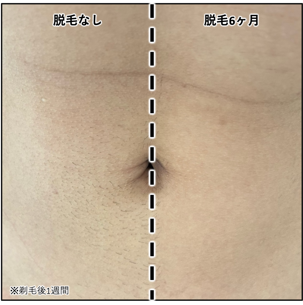 6ヶ月間左半身だけ脱毛した結果